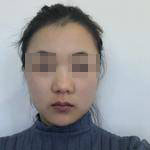 上海瑞麗整形醫(yī)生金炳建做肋軟骨隆鼻技術(shù)怎么樣？金炳建做肋軟骨隆鼻案例