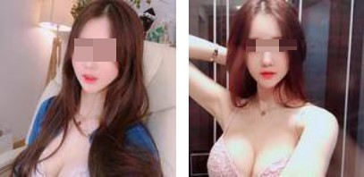 沈陽杏林整形美容醫(yī)院崔昌墉醫(yī)生做假體隆胸技術(shù)怎么樣？附案例