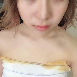 孫軼峰做假體隆胸案例效果對比圖 孫軼峰做假體隆胸案例效果對比圖