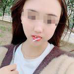 石家莊美然醫(yī)療整形醫(yī)生劉超做激光祛疤效果怎么樣？附劉超醫(yī)生案例