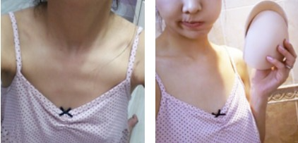 沈陽(yáng)杏林整形美容醫(yī)院崔昌墉醫(yī)生做假體隆胸技術(shù)怎么樣？附案例