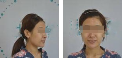 昆明麗都整形醫(yī)生孟春麗做面部自體脂肪填充效果怎么樣？