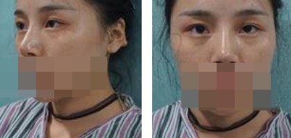 寧波美仁整形美容醫(yī)院李英大醫(yī)生做切開雙眼皮效果怎么樣？