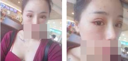 寧波美仁整形美容醫(yī)院李英大醫(yī)生做切開雙眼皮效果怎么樣？