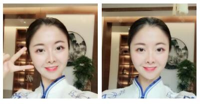 深圳嶺南醫(yī)院整形醫(yī)生丁祖鑫做假體豐太陽穴案例效果對比圖