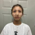 濟(jì)南鵬愛整形醫(yī)生楊力做顴骨顴弓整形技術(shù)怎么樣？楊力醫(yī)生案例展示