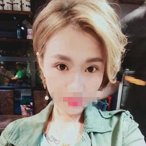 雙眼皮手術(shù)第十五天 雙眼皮手術(shù)第十五天