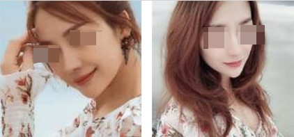 上海攸維醫(yī)療美容診所整形醫(yī)生李靜做膨體隆鼻效果怎么樣？附案例展示