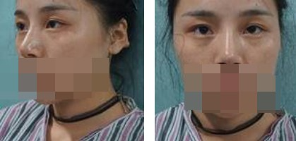 寧波美仁整形美容醫(yī)院李英大醫(yī)生做切開(kāi)雙眼皮效果怎么樣？