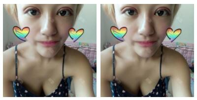 東莞華美做切開(kāi)雙眼皮怎么樣？朱清武醫(yī)生切開(kāi)雙眼皮案例分享