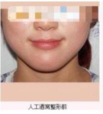 德州市第二人民醫(yī)院燒傷美容整形科張波濤醫(yī)生做酒窩成形術(shù)怎么樣？