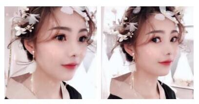 上海首爾麗格整形醫(yī)生魯峰一做自體脂肪全臉填充效果怎么樣？