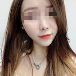 深圳尚虹醫(yī)療整形醫(yī)生藍(lán)劍雄做自體脂肪豐面頰效果怎么樣？附案例