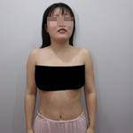 南寧伊美整形醫(yī)生凌宏量做自體脂肪隆胸怎么樣?自體脂肪隆胸案例