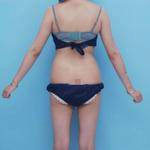 青島銘醫(yī)醫(yī)學(xué)整形醫(yī)生王殿棟做全身吸脂效果怎么樣？附案例展示