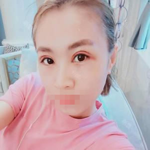 雙眼皮手術(shù)第二天 雙眼皮手術(shù)第二天