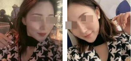 蘭州美月整形美容醫(yī)院文輝才醫(yī)生做鼻綜合整形效果怎么樣？附鼻綜合案例