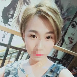 雙眼皮手術(shù)第二十天 雙眼皮手術(shù)第二十天