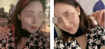 術(shù)后照片 術(shù)后照片