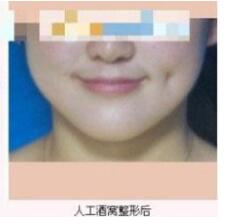 整形醫(yī)生張波濤酒窩成形術案例