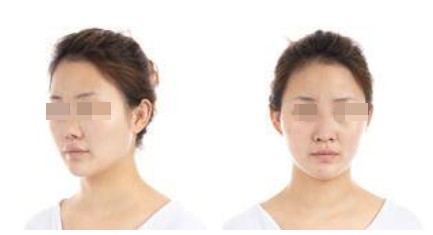 術(shù)前照片 術(shù)前照片