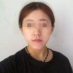 做完埋線提升后，松弛的臉蛋拜拜了