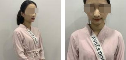 自體軟骨隆鼻案例 自體軟骨隆鼻案例