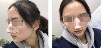 自體軟骨隆鼻案例 自體軟骨隆鼻案例