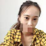 隆鼻+雙眼皮手術(shù)讓我成功蛻變，顏值達(dá)到巔峰