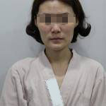 做完自體脂肪豐面頰后，我的面部比例更加完美了呢