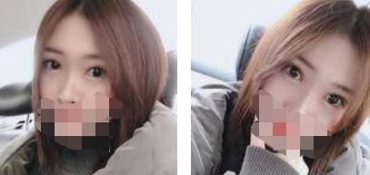 激光祛眼袋恢復(fù)過程 激光祛眼袋恢復(fù)過程