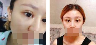 全切雙眼皮恢復(fù)過(guò)程