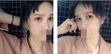 手術(shù)后的照片