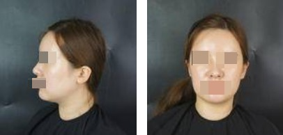 面部吸脂讓你做一個(gè)更受歡迎的精致“小臉”的女人