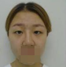 做了全切雙眼皮不僅外表變美了，內(nèi)心也更加自信了