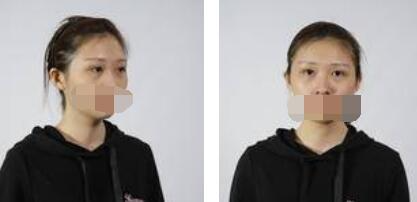 沒有了眼袋困擾，身體和心態(tài)都年輕了十歲