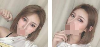 鼻綜合+眼綜合整形，讓我美的更自然，再也不用p圖了