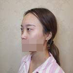 隆鼻+雙眼皮手術(shù)讓我成功蛻變，顏值達(dá)到巔峰