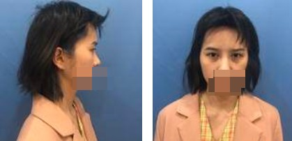 做了切開雙眼皮手術(shù)，才發(fā)現(xiàn)自己原來可以這么美！