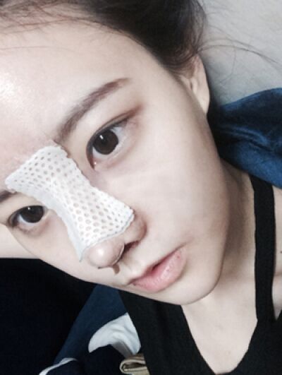 貴陽長江醫(yī)院整形美容中心韓盛斌醫(yī)生做自體脂肪隆鼻+全臉填充案例