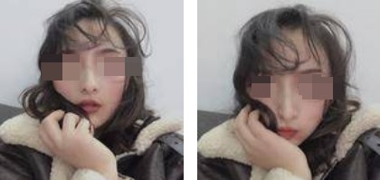 自體軟骨隆鼻案例 自體軟骨隆鼻案例