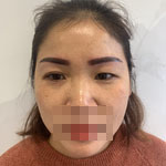 雙眼皮修復給我重新帶來了自信和面對生活的勇氣