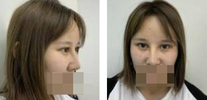 鼻綜合+眼綜合整形，讓我美的更自然，再也不用p圖了