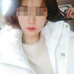 做完自體脂肪豐面頰后，我的面部比例更加完美了呢