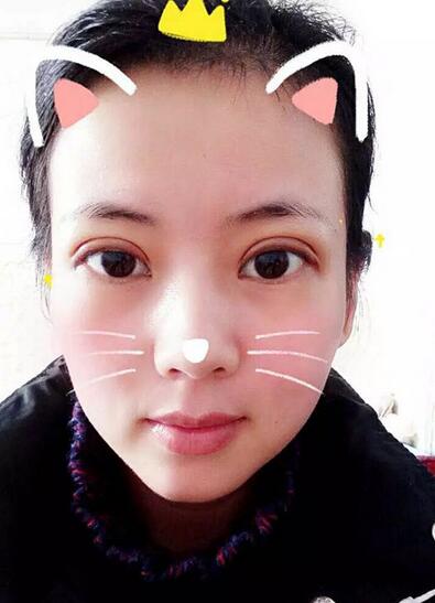 楊勇山雙眼皮案例展示