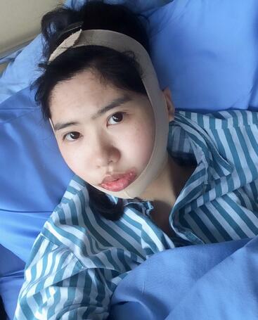 下頜角手術(shù)第四天