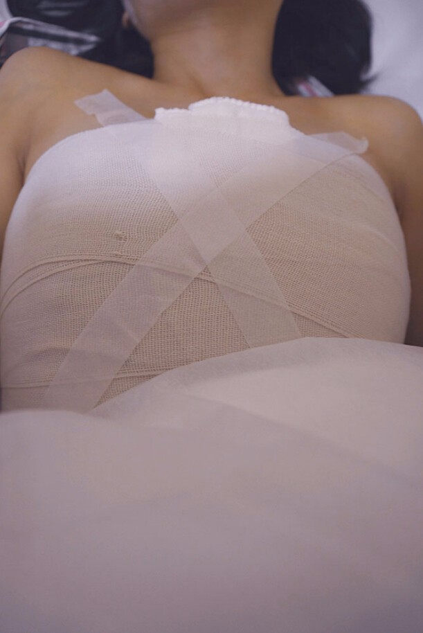 馬戰(zhàn)勝自體脂肪隆胸案例效果對比圖