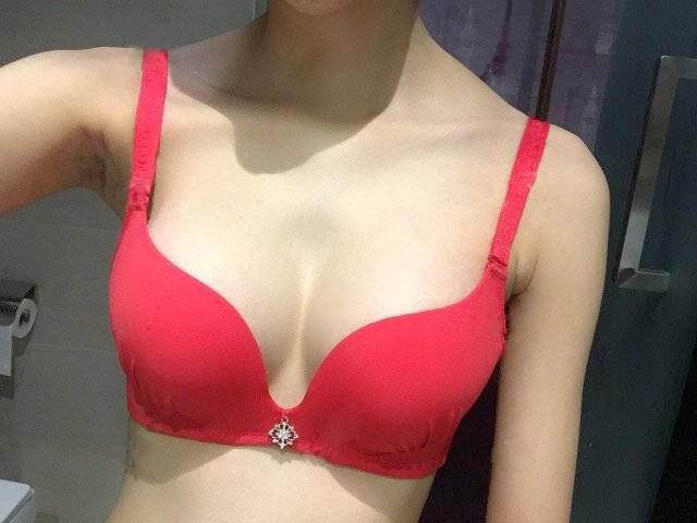 嘉興華山陳榮忠假體隆胸案例