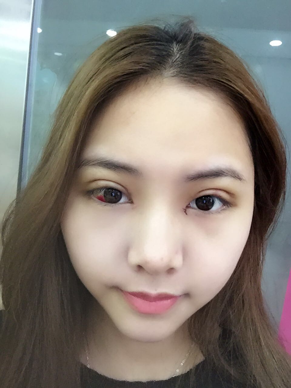 整形醫(yī)生徐長亮做切開雙眼皮案例效果對比圖 整形醫(yī)生徐長亮做切開雙眼皮案例效果對比圖