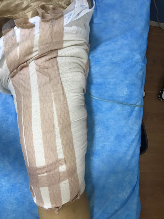 廣州軍頤醫(yī)院整形美容中心石建薇醫(yī)生腰腹吸脂真實(shí)案例對(duì)比圖 廣州軍頤醫(yī)院整形美容中心石建薇醫(yī)生腰腹吸脂真實(shí)案例對(duì)比圖